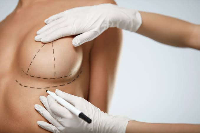Breast Lift