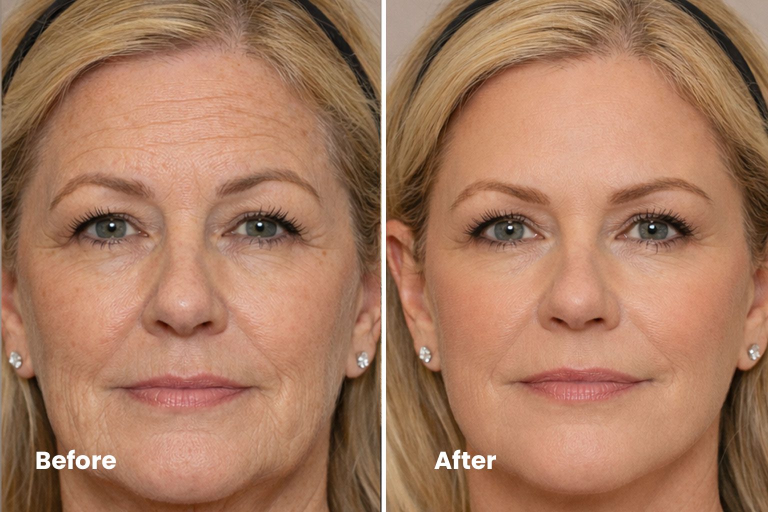 Forehead Lift