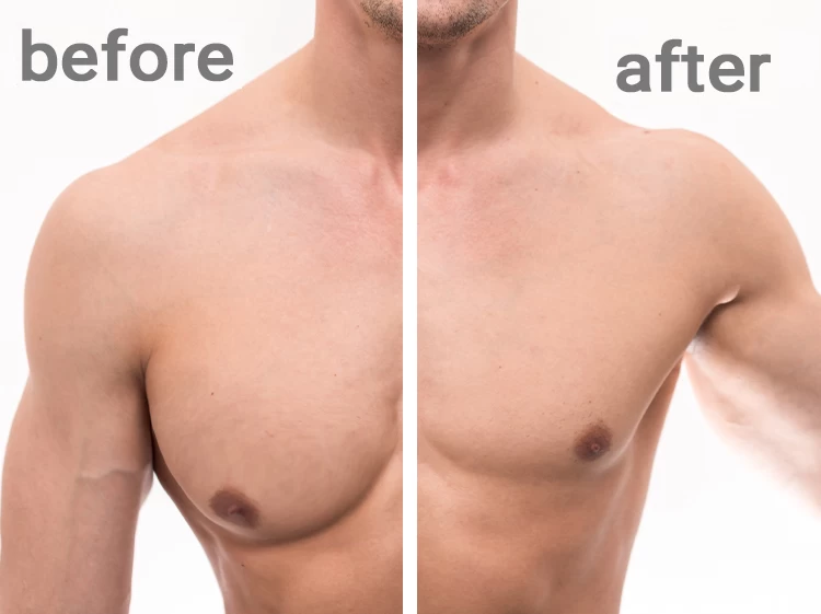 Gynecomastia
